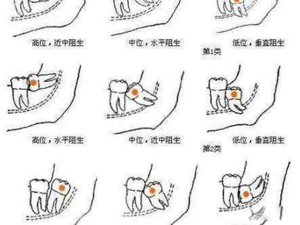 拔智齿会很疼吗 拔智齿注意事项与禁忌后悔了