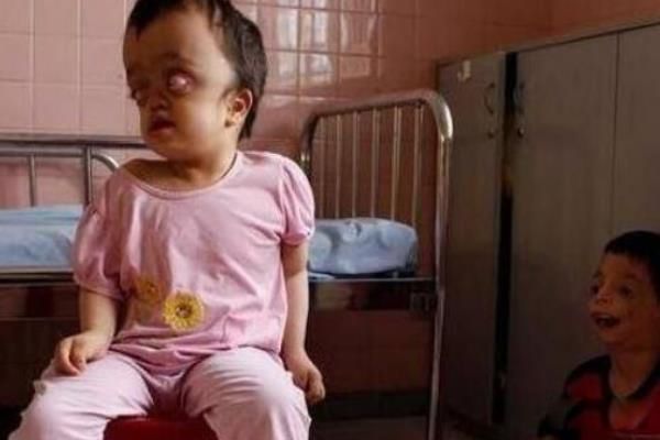 福岛现状日本福岛变异人 侥幸存活下来的福岛变异畸形儿