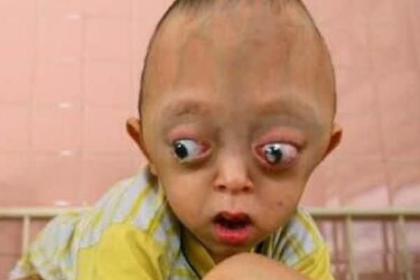 福岛现状日本福岛变异人 侥幸存活下来的福岛变异畸形儿