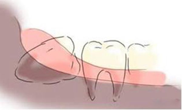 拔智齿会很疼吗 拔智齿注意事项与禁忌后悔了