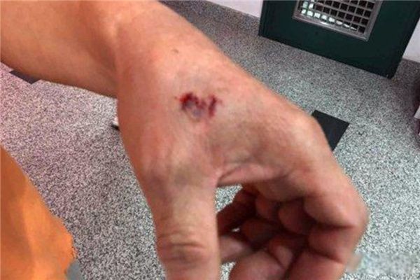 疯狗咬人发作真实事件 十堰市突发疯狗咬人事件