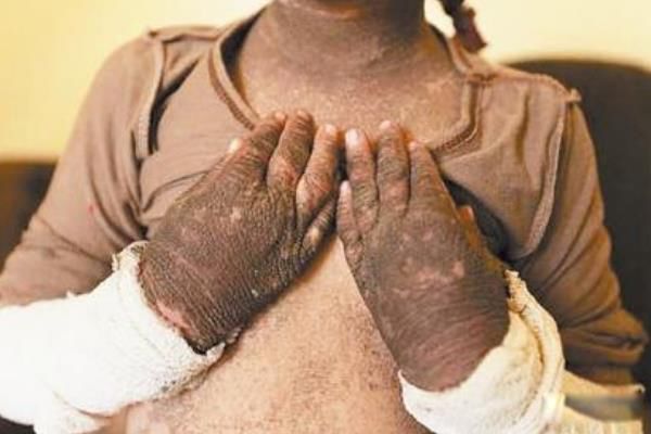 芥子毒气吸入会怎么样 毒气杀伤力有多大