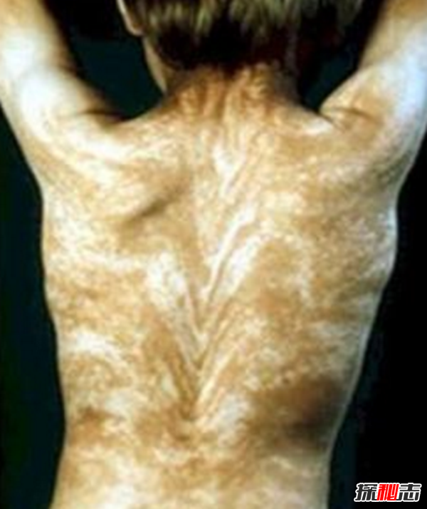 Blaschko����֢��ʲô�� �����������Ĺֲ�֢