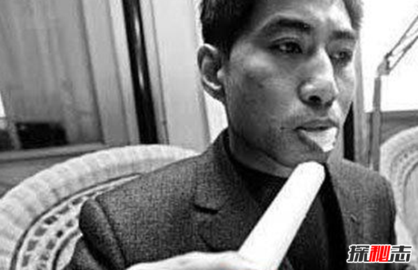 Blaschko����֢��ʲô�� �����������Ĺֲ�֢