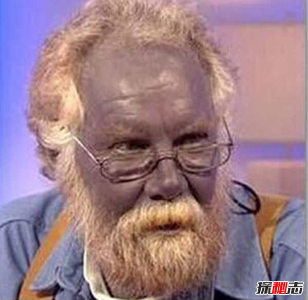 Blaschko����֢��ʲô�� �����������Ĺֲ�֢