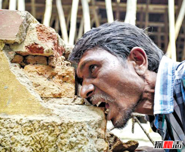 Blaschko����֢��ʲô�� �����������Ĺֲ�֢