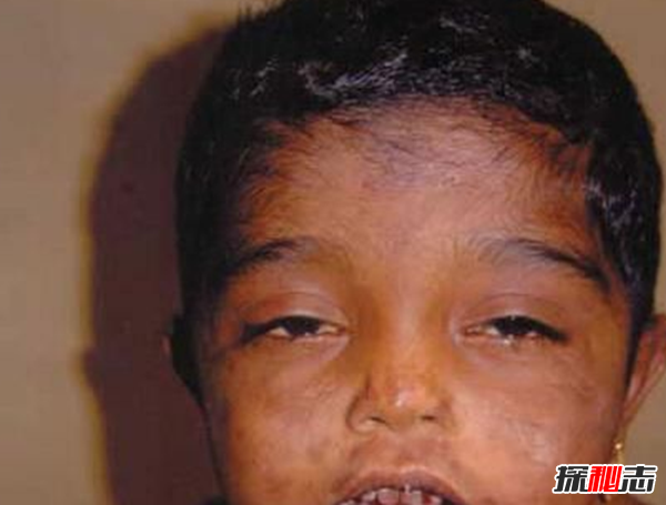 Blaschko����֢��ʲô�� �����������Ĺֲ�֢