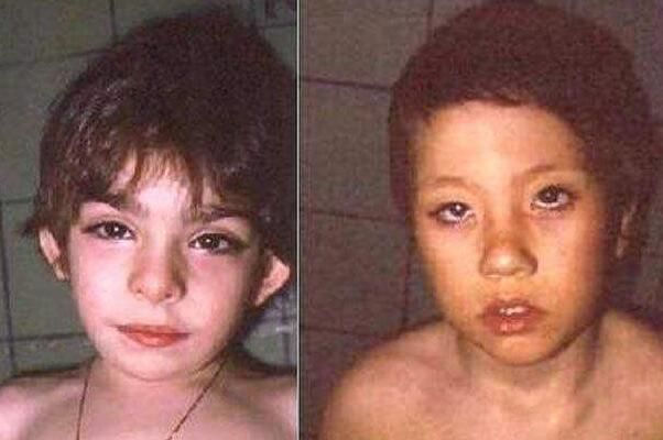 歌舞伎面谱综合症是什么引起的 歌舞伎综合征患者照片(很漂亮)