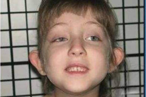 歌舞伎面谱综合症是什么引起的 歌舞伎综合征患者照片(很漂亮)