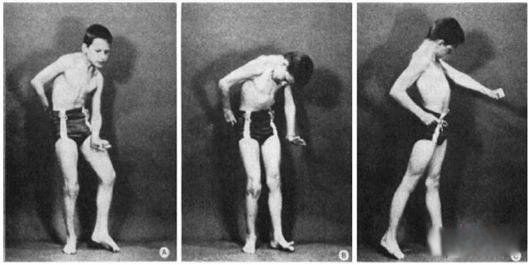 ���������赸֢�����ĸ����ҵ����� ��͢�����赸֢�ķ���ԭ���ǻ���