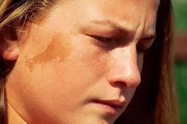 �����ֱ�������ɫ̥��ʲô�� �ֱ�����ɫ̥�Ǵ���ʲô