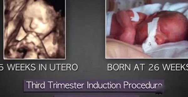 ��̥�Ĺ����뻯�ⷽ������ ��̥�ĺ���ȥ������