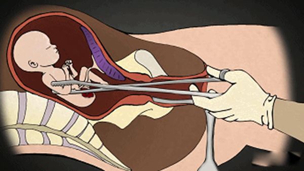 ��̥�Ĺ����뻯�ⷽ������ ��̥�ĺ���ȥ������