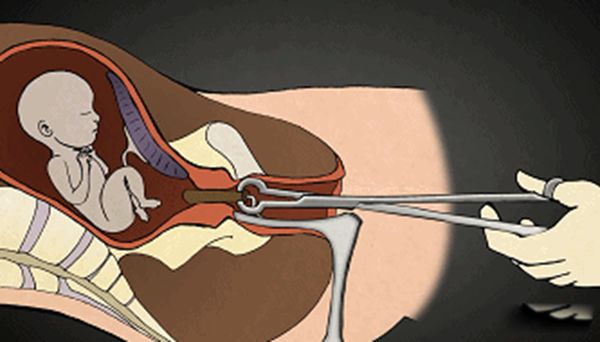 ��̥�Ĺ����뻯�ⷽ������ ��̥�ĺ���ȥ������