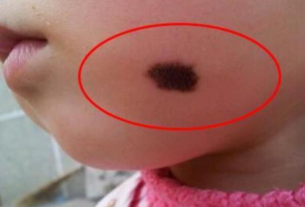 ��ɫ̥�ǵ�λ�������� ��ɫ̥�Ǵ���ʲôԤ��