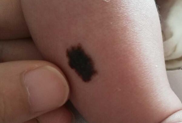 ��ɫ̥�ǵ�λ�������� ��ɫ̥�Ǵ���ʲôԤ��