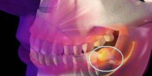 智齿可以不拔吗 智齿必须要拔掉吗?为什么