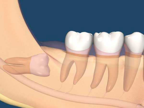 智齿可以不拔吗 智齿必须要拔掉吗?为什么