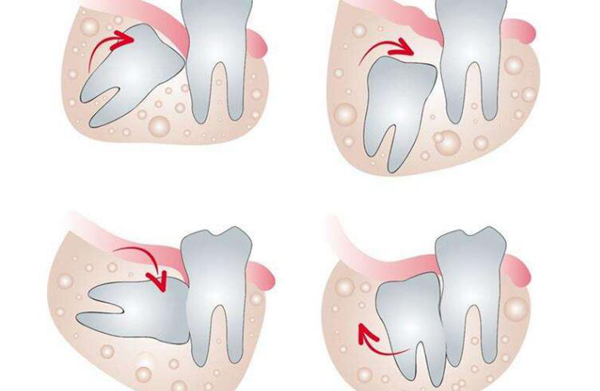 智齿可以不拔吗 智齿必须要拔掉吗?为什么
