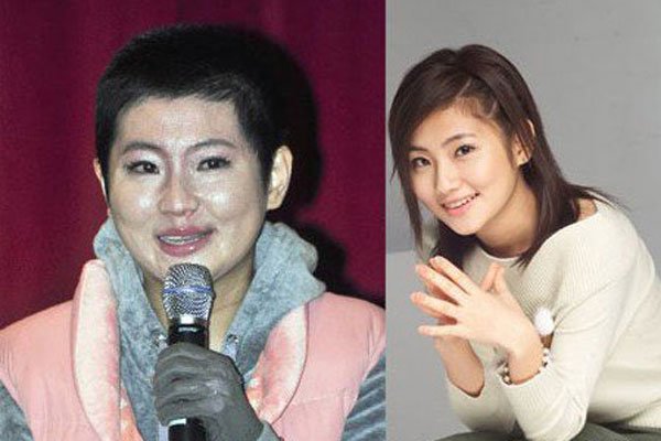 任家萱烧伤前后对比照 大面积留疤恐怖到丈夫都嫌弃