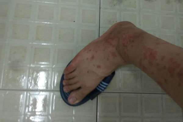 ����ҧ�ĳ���֢״ͼƬ �����������Ⱦһ��Ƭ