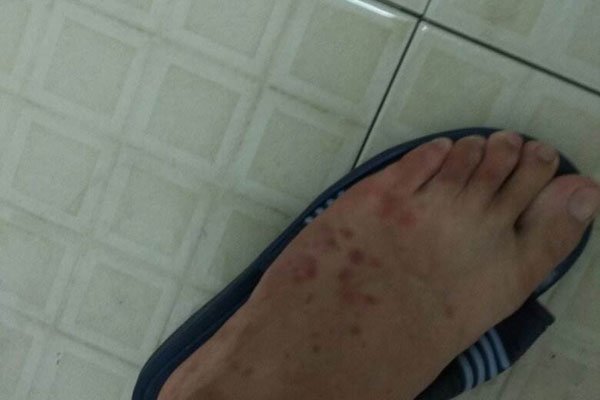 臭虫咬的初期症状图片 卫生瘙痒会感染一大片