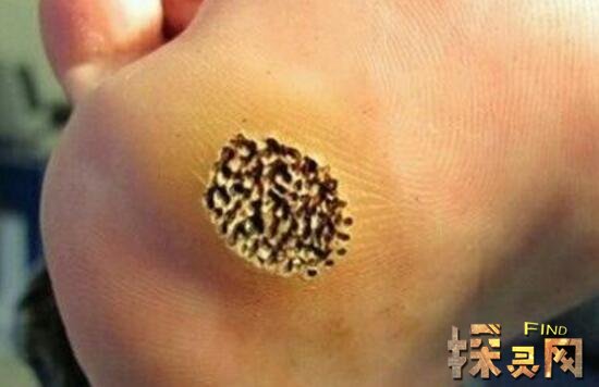 蓬蓬乳是什么意思 有这种病但网传图是假的