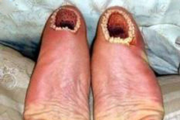 什么是空手指莲蓬乳芝麻女孩 密集恐惧症图片是真实的吗