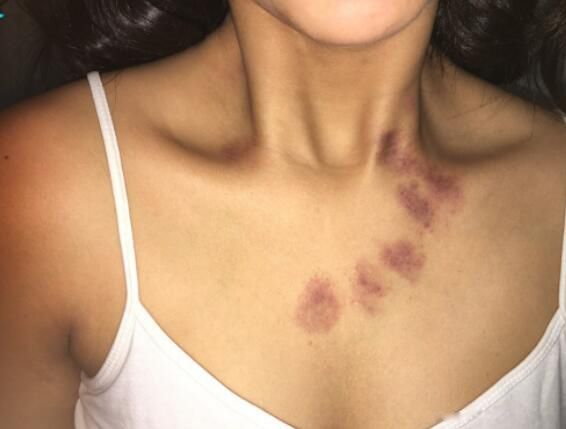 ��������˵Ҫ��С��ݮָʲô ����ݮ�᲻���������