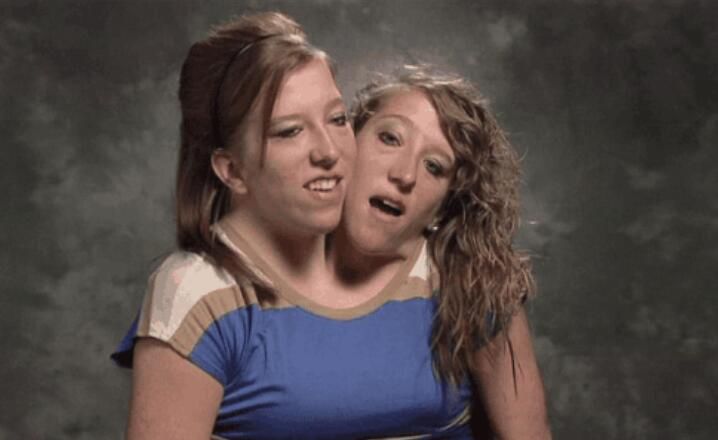 双头人姐妹还活着吗 感情问题:双头人姐妹的婚姻生活现状